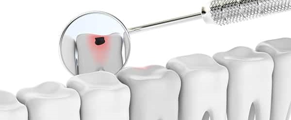 歯を削らないCR修復治療法